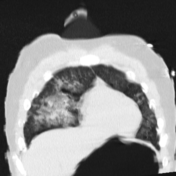 Acute aspiration pneumonitis (Radiopaedia 33605-34703 Coronal lung window 22).jpg