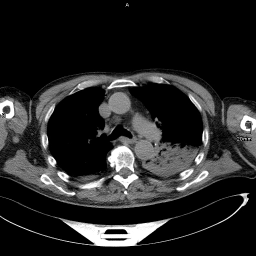 Acute aspiration pneumonitis (Radiopaedia 55642-62166 Axial liver window 25).jpg