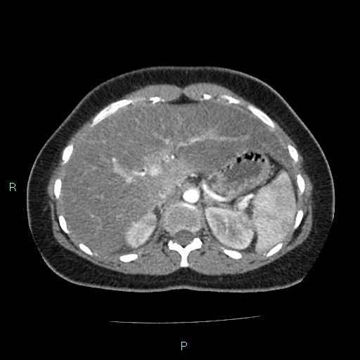 Acute bilateral pyelonephritis (Radiopaedia 37146-38881 Axial C+ arterial phase 44).jpg