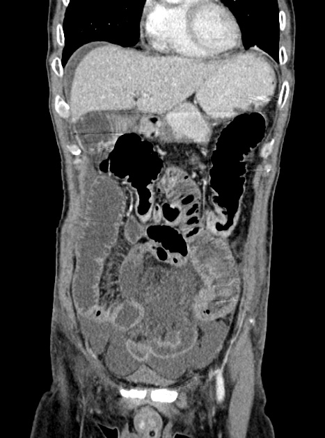 Acute bowel ischemia (Radiopaedia 87695-104114 Coronal C+ portal venous phase 133).jpg