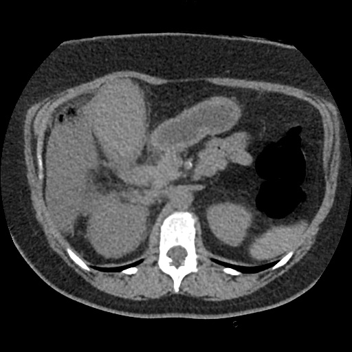 Acute cholecystitis and ureteric colic (Radiopaedia 42330-45444 Axial prone 30).jpg