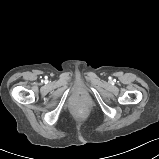 File:Acute cholecystitis with contained perforation (Radiopaedia 47328-51907 Axial C+ portal venous phase 79).png