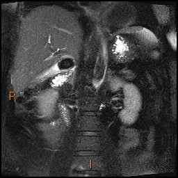 File:Acute cholecystitis with gallbladder neck calculus (Radiopaedia 42795-45971 Coronal T2 Half-fourier-acquired single-shot turbo spin echo (HASTE) 1).jpg