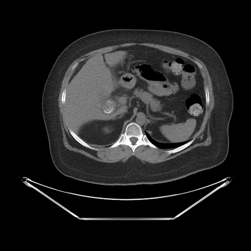 File:Acute cholecystitis with tensile fundus sign (Radiopaedia 71394-81723 Axial non-contrast 13).jpg