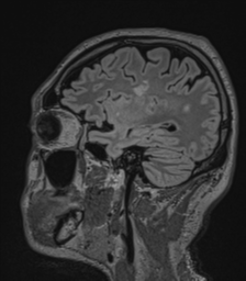 Acute disseminated encephalomyelitis (ADEM)- Anti-NMDA receptor encephalitis (Radiopaedia 54920-61201 Sagittal FLAIR 28).png