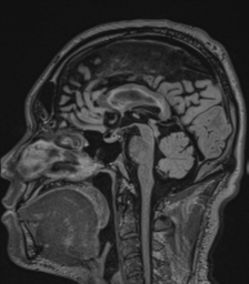 Acute disseminated encephalomyelitis (ADEM)- Anti-NMDA receptor encephalitis (Radiopaedia 54920-61201 Sagittal FLAIR 44).png