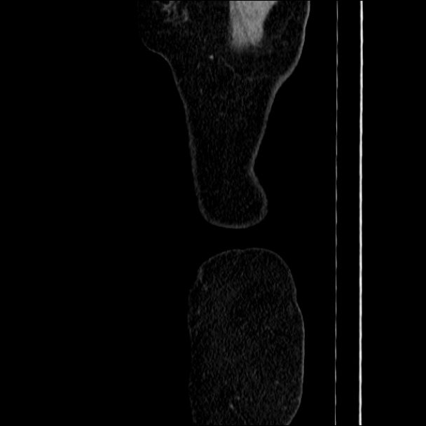Acute diverticulitis (Radiopaedia 34183-35442 Sagittal C+ portal venous phase 103).jpg