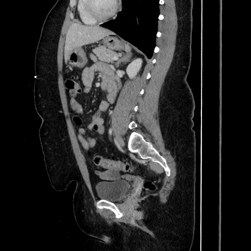 Acute diverticulitis - transverse colon (Radiopaedia 87063-103327 Sagittal C+ portal venous phase 138).jpg