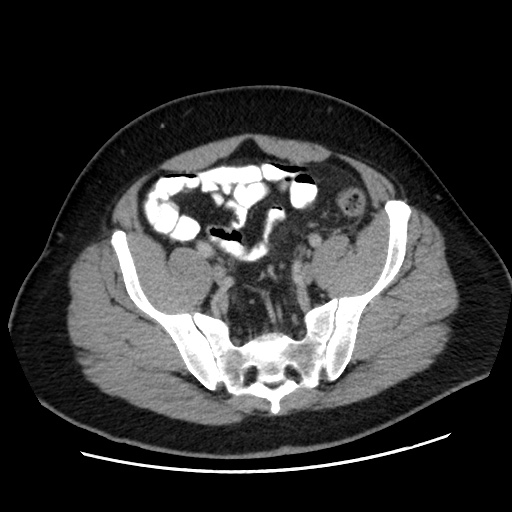 File:Acute diverticulitis with localized perforation (Radiopaedia 41296-44113 Axial C+ portal venous phase 71).jpg