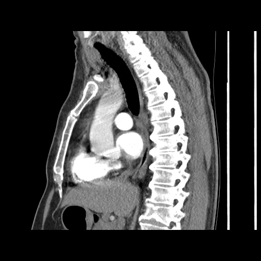 Acute epicardial fat necrosis (Radiopaedia 42327-45440 Sagittal C+ CTPA 36).jpg