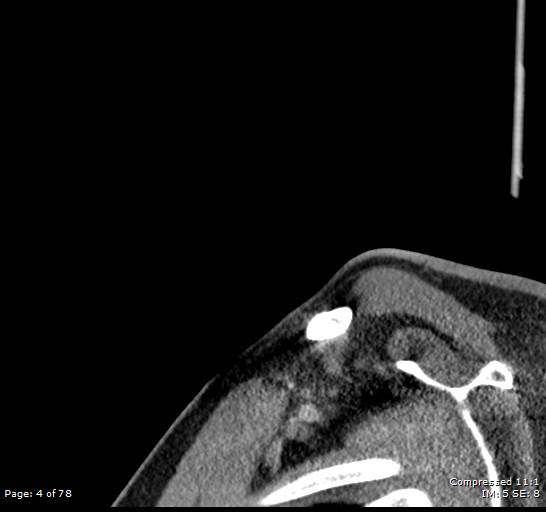 Acute epiglottitis (Radiopaedia 54375-60590 Sagittal C+ arterial phase 4).jpg