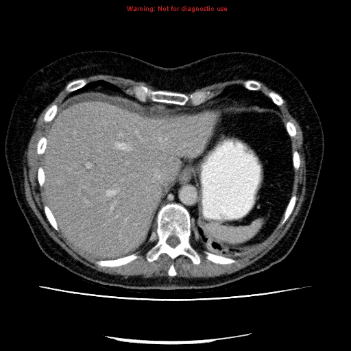 Acute gangrenous cholecystitis (Radiopaedia 10123-10661 Axial C+ portal venous phase 16).jpg