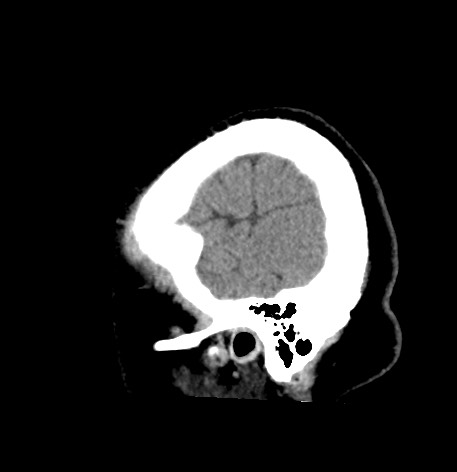 Acute internal carotid artery dissection (Radiopaedia 53541-59558 Sagittal non-contrast 57).jpg