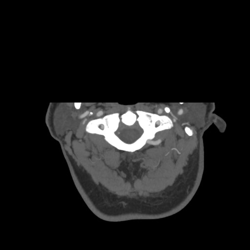File:Acute internal carotid artery dissection (Radiopaedia 53541-59630 D 1).jpg