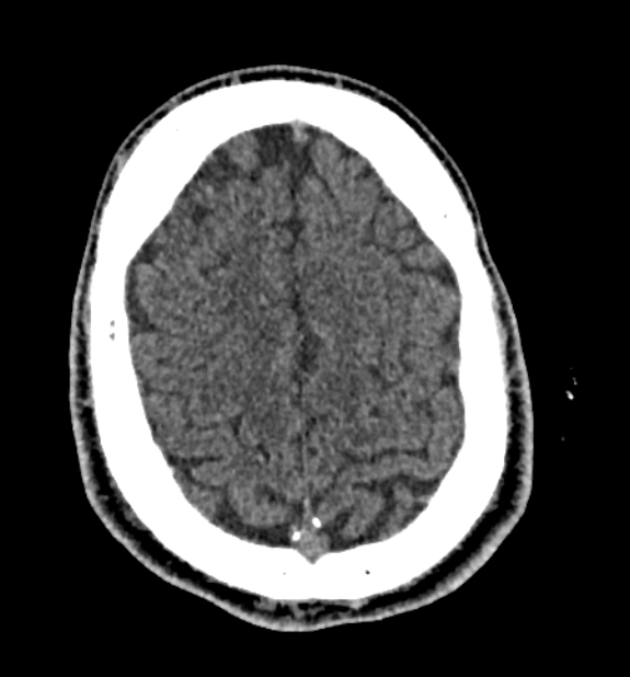 Acute ischemic stroke - posterior circulation territory (Radiopaedia 77670-89881 non-contrast 75).jpg