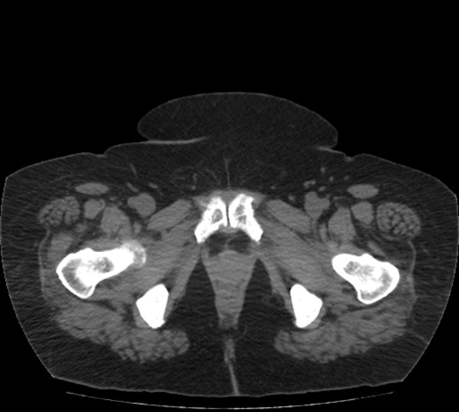 Acute mesenteric ischemia (Radiopaedia 80029-93316 Axial non-contrast 89).jpg