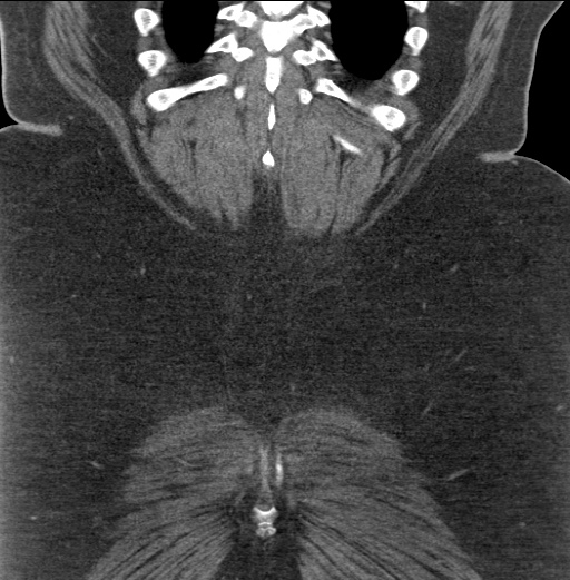 Acute mesenteric venous ischemia (Radiopaedia 46041-50383 Coronal C+ portal venous phase 89).jpg