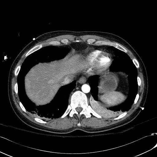 File:Acute myocardial infarction in CT (Radiopaedia 39947-42415 Axial C+ arterial phase 116).jpg