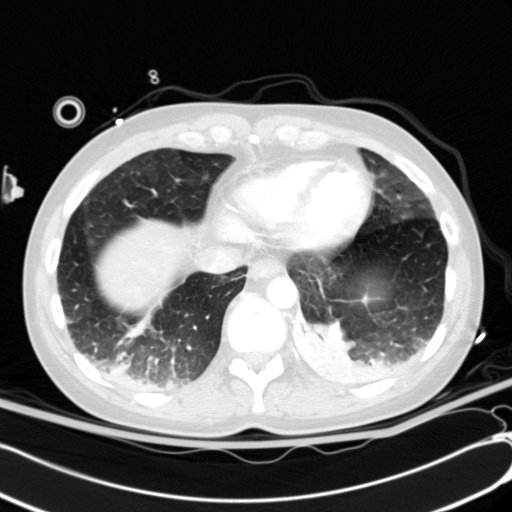 Acute myocardial infarction in CT (Radiopaedia 39947-42415 Axial lung window 105).jpg