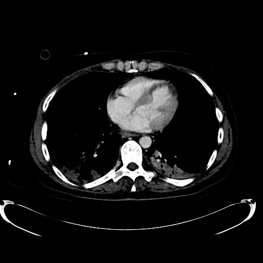 File:Acute myocardial infarction in CT (Radiopaedia 39947-42457 Axial C+ portal venous phase 2).jpg