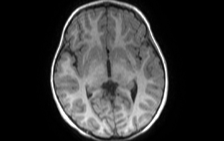 File:Acute necrotizing encephalitis of childhood (Radiopaedia 67356-76737 Axial T1 51).jpg