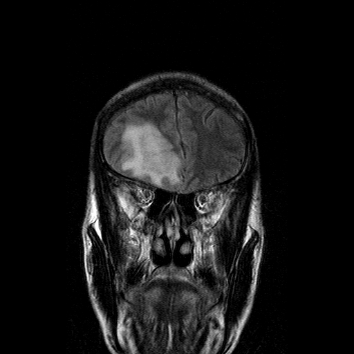 File:Acute necrotizing toxoplasma encephalitis (Radiopaedia 10683-11149 Coronal FLAIR 16).jpg