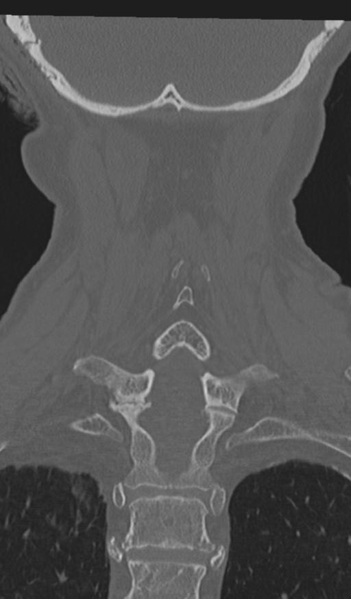 Acute on chronic subdural hematoma and thoracic vertebral injury in a multitrauma patient (Radiopaedia 31698-32619 Coronal bone window 50).jpg