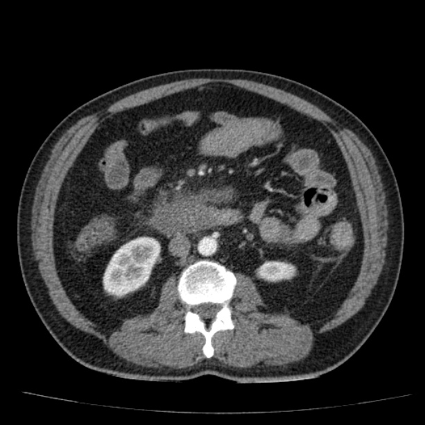 Acute pancreatitis (Radiopaedia 26663-26813 Axial C+ arterial phase 52).jpg