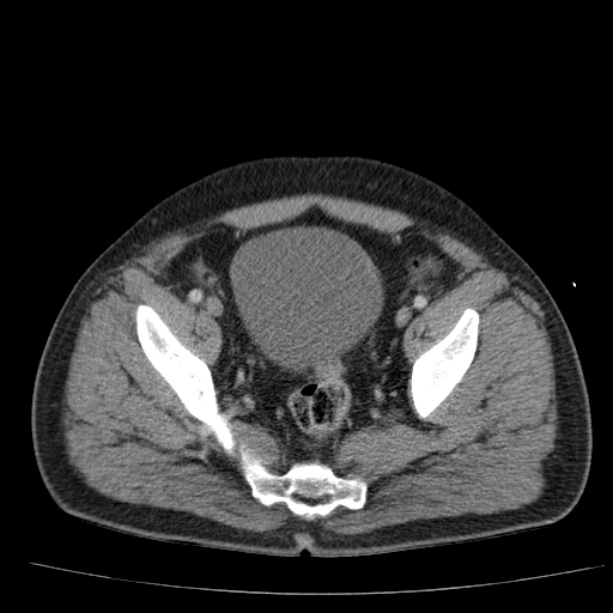 Acute pancreatitis (Radiopaedia 26663-26813 Axial C+ portal venous phase 74).jpg