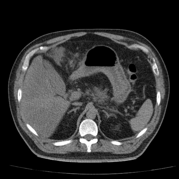 Acute pancreatitis (Radiopaedia 26663-26813 Axial non-contrast 29).jpg
