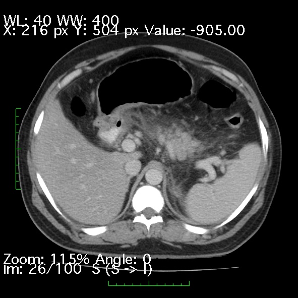 Acute pancreatitis (Radiopaedia 34043-35276 Axial C+ portal venous phase 26).jpg