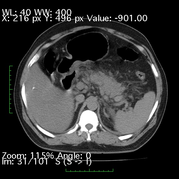Acute pancreatitis (Radiopaedia 34043-35276 Axial non-contrast 31).jpg