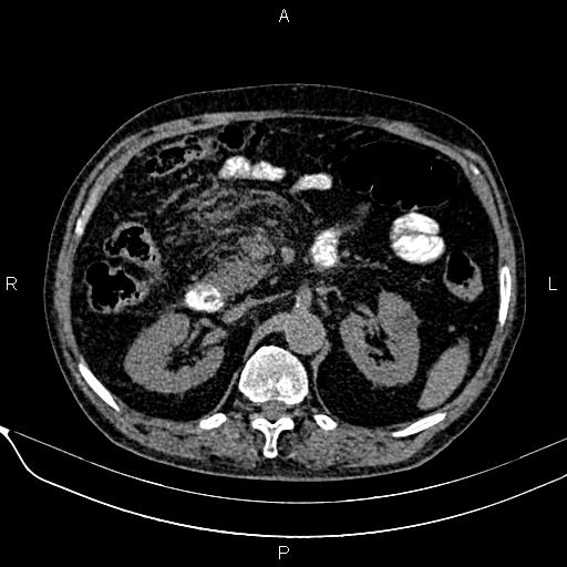 Acute pancreatitis (Radiopaedia 85146-100701 Axial non-contrast 48).jpg