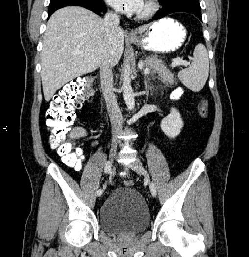 Acute pancreatitis (Radiopaedia 85390-101010 Coronal C+ portal venous phase 39).jpg