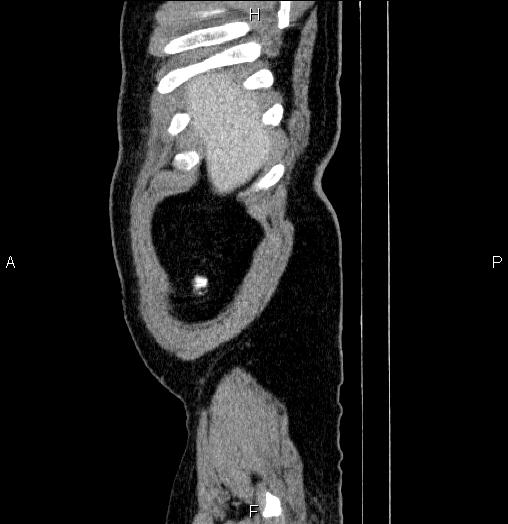 Acute pancreatitis (Radiopaedia 85390-101010 Sagittal C+ portal venous phase 2).jpg
