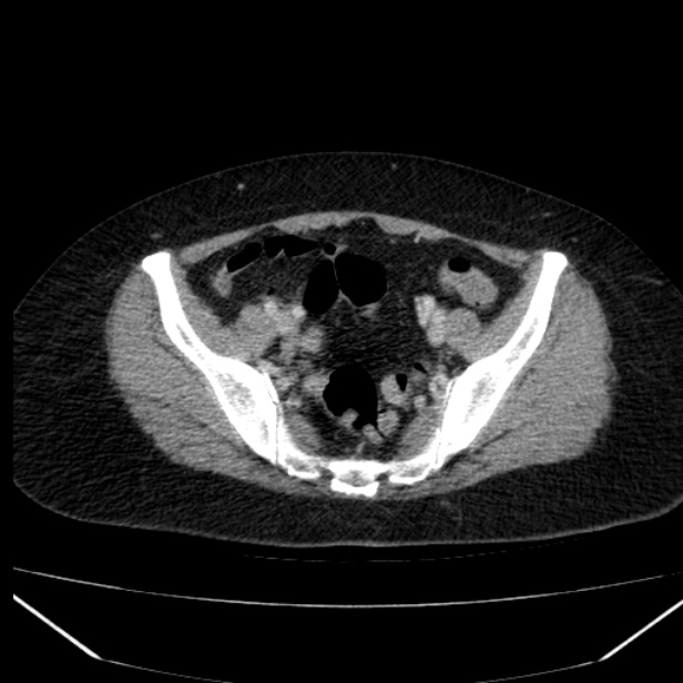 Acute pancreatitis - Balthazar C (Radiopaedia 26569-26714 Axial C+ portal venous phase 79).jpg