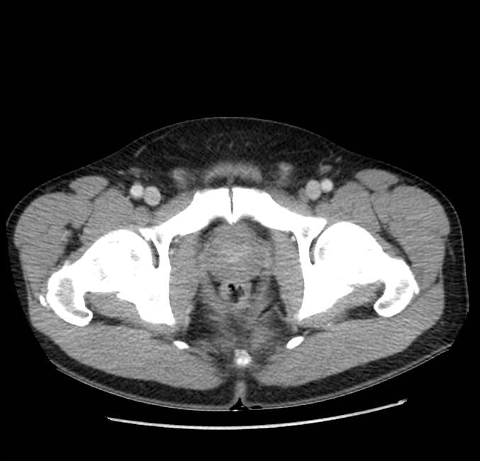 Acute pancreatitis - Balthazar E (Radiopaedia 23080-23110 Axial C+ portal venous phase 72).jpg