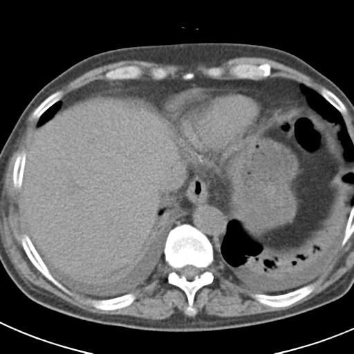 File:Acute pancreatitis and walled-off necrosis (Radiopaedia 29888-30403 Axial non-contrast 7).jpg