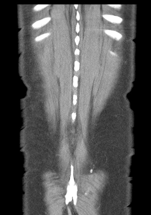 Acute pancreatitis and walled-off necrosis (Radiopaedia 29888-30403 E 52).jpg