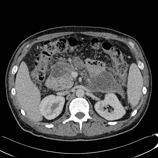 File:Acute pancreatitis with walled off pancreatic necrosis (Radiopaedia 6438-7797 Axial C+ portal venous phase 8).jpg