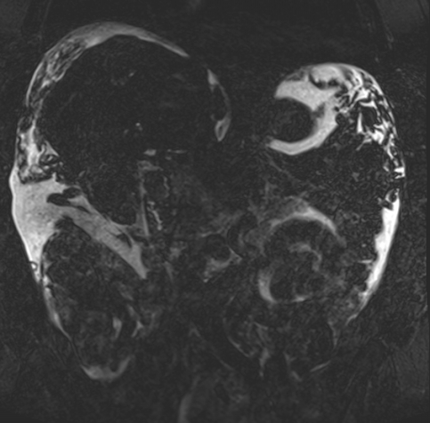 Acute portal vein thrombosis (Radiopaedia 73198-83925 Coronal Heavily T2 thin cuts 41).jpg