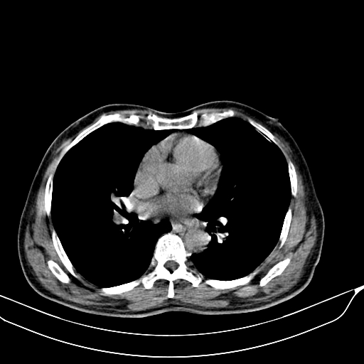 File:Acute pulmonary embolism (Radiopaedia 69510-79390 Axial non-contrast 23).jpg