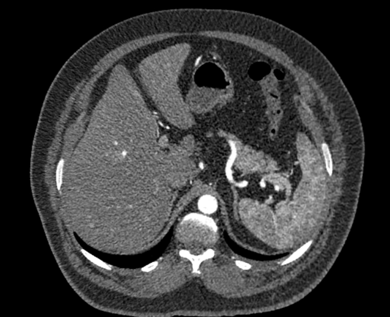 Acute pulmonary embolism with pulmonary infarcts (Radiopaedia 77688-89908 Axial C+ CTPA 72).jpg