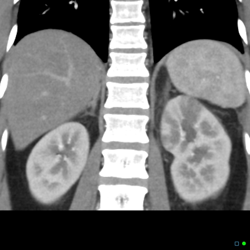 File:Acute pyelonephritis and emphysematous pyonephrosis (Radiopaedia 27893-28128 Coronal renal cortical phase 13).jpg
