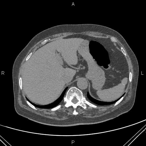 Acute renal artery occlusion (Radiopaedia 86586-102682 Axial non-contrast 12).jpg