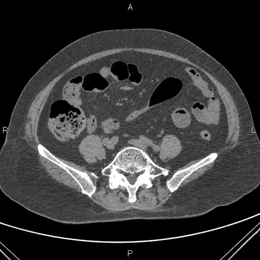 File:Acute renal artery occlusion (Radiopaedia 86586-102682 Axial non-contrast 60).jpg
