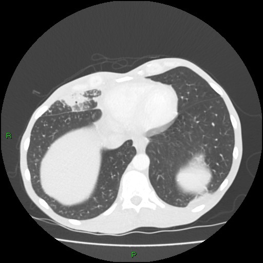 Acute right lung abscess (Radiopaedia 34806-36258 Axial lung window 151).jpg