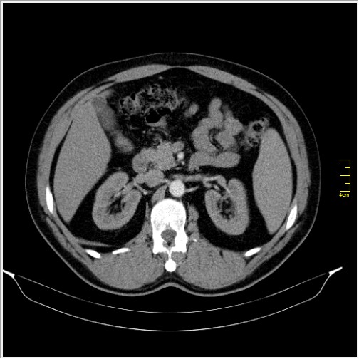 Acute right sided diverticulitis (Radiopaedia 65249-74268 Axial C+ portal venous phase 27).JPG