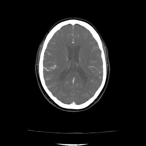 Acute subarachnoid hemorrhage and accessory anterior cerebral artery (Radiopaedia 69231-79009 Axial C+ arterial phase 103).jpg