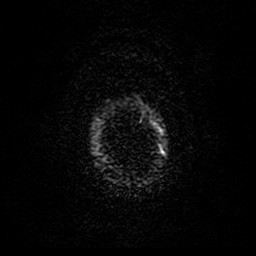 Acute superior cerebellar artery territory infarct (Radiopaedia 84104-99358 Axial DWI 68).jpg